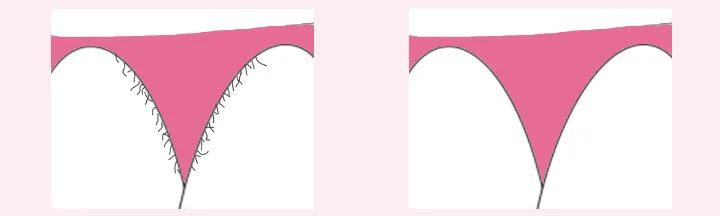 深圳私密脫毛，選擇雷射脫毛靠譜嗎