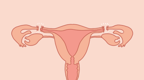 什么是輸卵管結(jié)紮?輸卵管結(jié)紮優(yōu)缺點